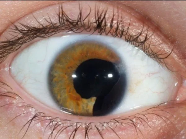 Şekere Bağlı Göz Hastalığı