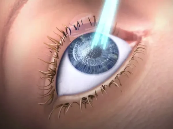 Excimer Lazer Ameliyatı