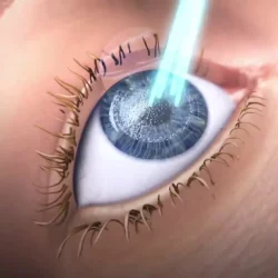 Excimer Lazer Ameliyatı